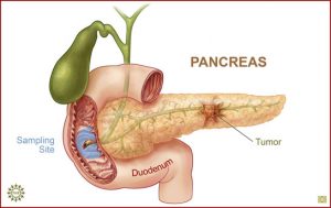 Tüp Mide Ameliyatından Sonra Pankreas Kanseri Riski Artıyor