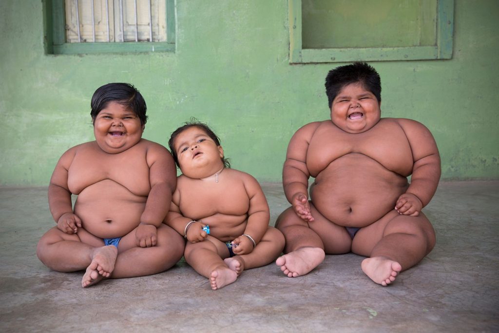 Çocuk obezitesi